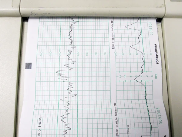 Featus beat and contraction graph — Stock Photo, Image