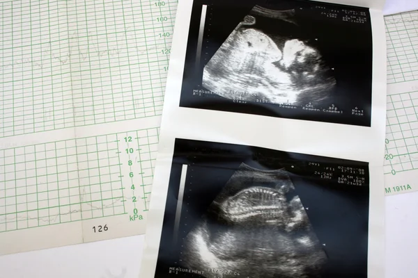 Sevgiliye ve ultrason