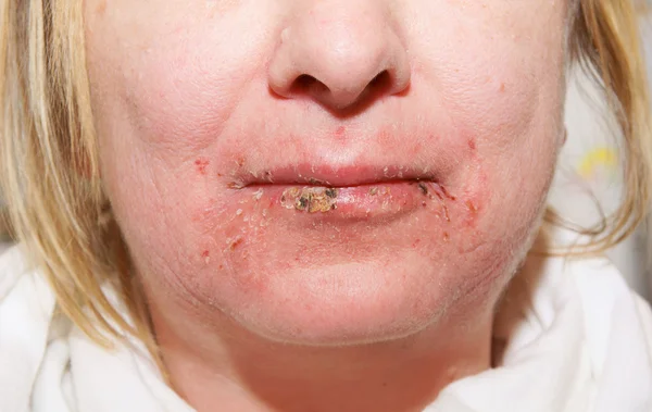 Skin disease — Stock Photo, Image