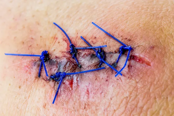 Fecho de uma ferida costurada Imagem De Stock