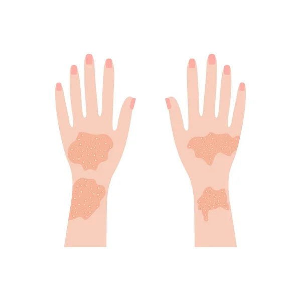 Mãos Humanas Com Psoríase Erupções Cutâneas Erupções Eczema Vermelho Eczema —  Vetores de Stock