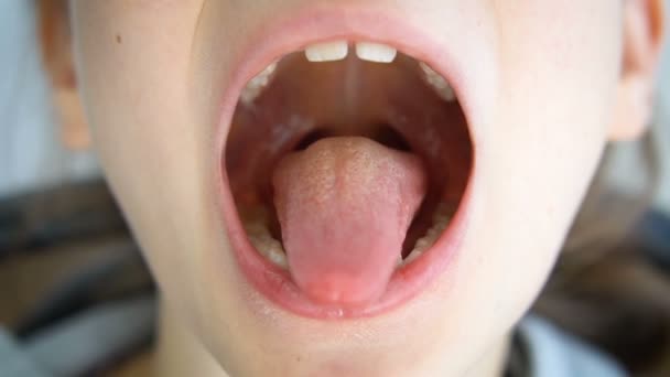 Ağzın açık, dilin dışarı çıkmış, uvülanın görünüşü ve küçük kızın yumuşak damak zevki, pediatrik dişçilik. — Stok video