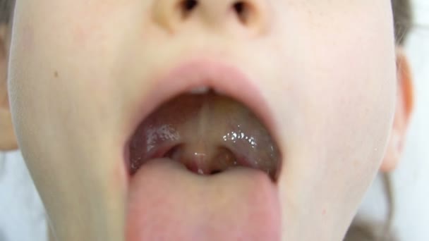 Weit geöffneter Mund mit herausgestreckter Zunge, Blick auf den Uvula und den weichen Gaumen eines kleinen Mädchens, Kinderzahnheilkunde — Stockvideo