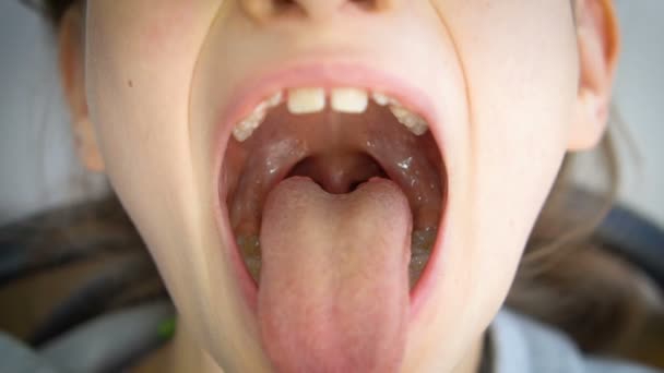 Bred öppen mun med en tunga stack ut, utsikt över uvula och den mjuka gommen av liten flicka, pediatrisk tandvård — Stockvideo