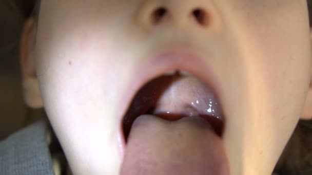 Ορθάνοιχτο στόμα με μια γλώσσα που προεξέχει, θέα της ωορρηξίας και του μαλακού ουρανίσκου του μικρού κοριτσιού, παιδιατρική οδοντιατρική — Αρχείο Βίντεο