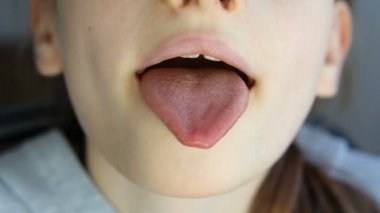 Ağzın açık, dilin dışarı çıkmış, uvülanın görünüşü ve küçük kızın yumuşak damak zevki, pediatrik dişçilik.