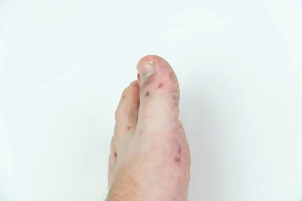 Human leg with dermatitis, allergy rash. Close up of males foot and toes with red rash desease. Enterovirus. Coxsackie virus. Allergic rash on the leg of an adult man — Stock Photo, Image