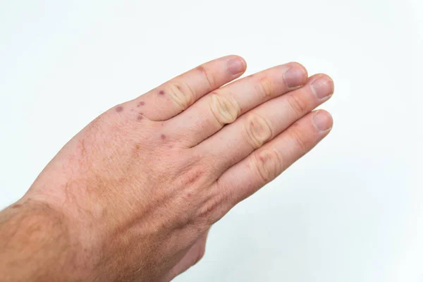 Болезненная сыпь, красные волдыри на руке человека. Человеческие руки с дерматитом, аллергическая сыпь. Энтеровирус. Вирус Коксаки. Аллергическая сыпь на руках взрослого мужчины — стоковое фото