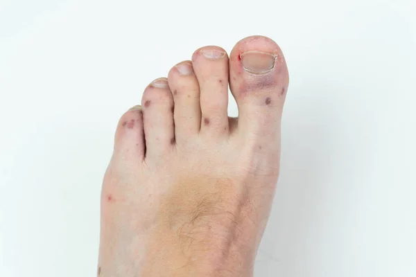 Painful rash, red blisters on a mans leg. Human leg with dermatitis, allergy rash. Enterovirus. Coxsackie virus. Allergic rash on the leg of an adult man — Stock Photo, Image