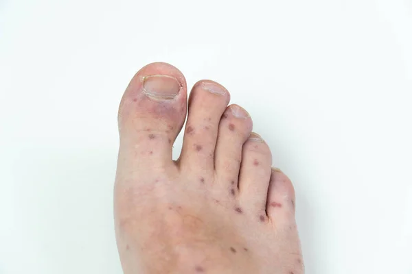 Болезненная сыпь, красные волдыри на ноге человека. Человеческая нога с дерматитом, аллергическая сыпь. Энтеровирус. Вирус Коксаки. Аллергическая сыпь на ноге взрослого мужчины — стоковое фото