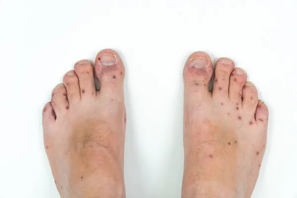 Человеческие ноги с дерматитом, аллергическая сыпь. Закрыть мужчин ноги и пальцы ног с красной сыпи болезни. Энтеровирус. Вирус Коксаки. Аллергическая сыпь на ногах взрослого мужчины — стоковое фото