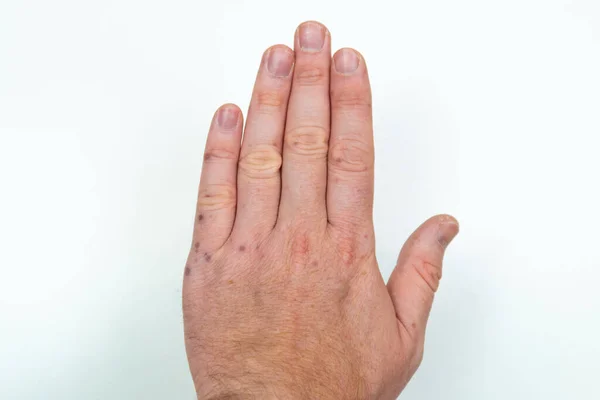 Painful rash, red blisters on a mans arm. Human hands with dermatitis, allergy rash. Enterovirus. Coxsackie virus. Allergic rash on the hands of an adult man — Stock Photo, Image