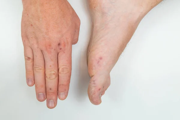 Аллергическая сыпь на руке и ноге взрослого мужчины. Болезненная сыпь, красные волдыри на руках и ногах. Человеческая рука и нога с дерматитом, аллергическая сыпь. Энтеровирус. Вирус Коксаки — стоковое фото