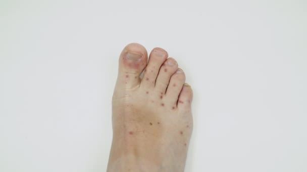 Болезненная сыпь, красные волдыри на ноге человека. Человеческая нога с дерматитом, аллергическая сыпь. Энтеровирус. Вирус Коксаки. Аллергическая сыпь на ногах взрослого мужчины — стоковое видео