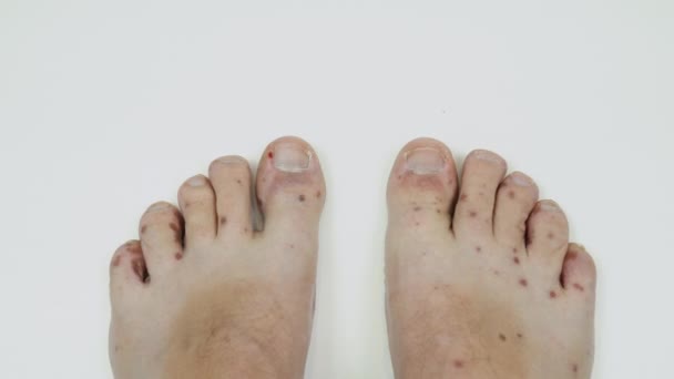 Pernas humanas com dermatite, erupção alérgica. Fechar-se de pés machos e dedos dos pés com desconforto erupção vermelha. Enterovírus. Vírus Coxsackie. Erupção alérgica nas pernas de um homem adulto — Vídeo de Stock