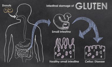 Intestinal Damage of Gluten clipart