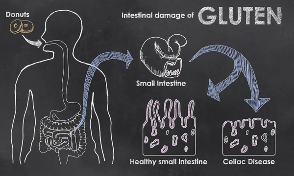 Intestinal Damage of Gluten — Stock Photo, Image