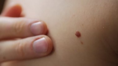 Vücut Dermatolojisindeki Benler
