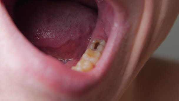 Black Tooth Caries — Stock Video