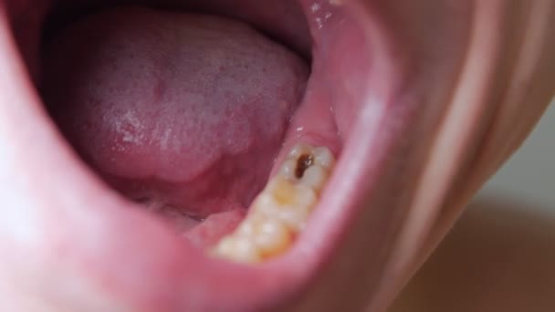 Svart hål i tanden — Stockvideo