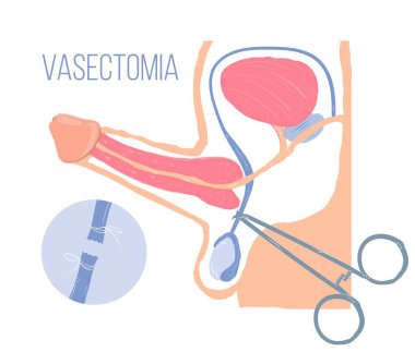 Illustration of male organ health, vasectomy and infertility