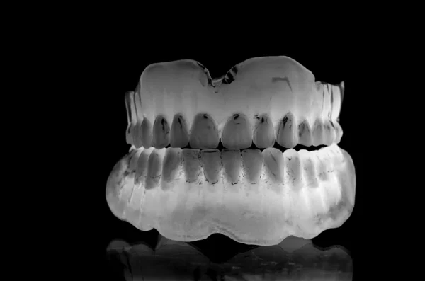 ACRYLIC DENTURE- FULL FRONT SET — Stock Photo, Image