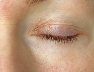 Genç bir kadının gözlerinde yağ, üst hareket edebilen göz kapağında küçük beyaz bir arı. Göz hastalıkları, dermatolog, omentum, kaşıntı ve irin. Kızın kapalı gözünün yakın çekimi..