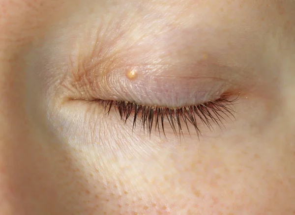 Fett Auf Dem Auge Einer Jungen Frau Ein Kleiner Weißer — Stockfoto