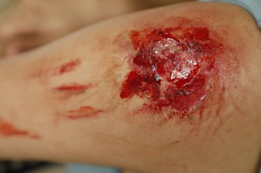 Indian Female body with Wound