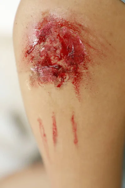 Indian Female Body Wound — Stockfoto