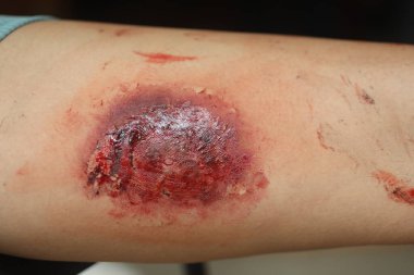 Indian Female body with Wound
