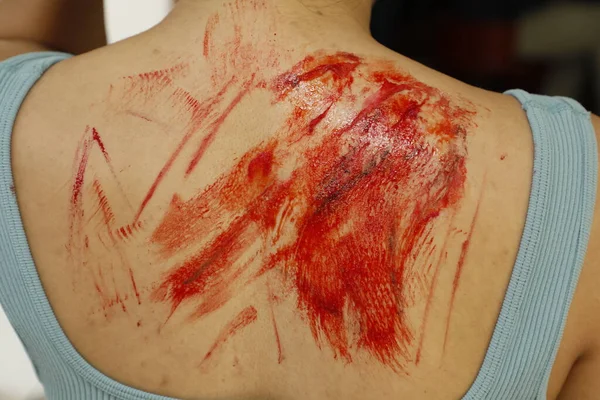 Indian Female Body Wound — Stockfoto