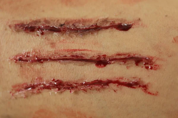 Indian Female Body Wound — Stockfoto