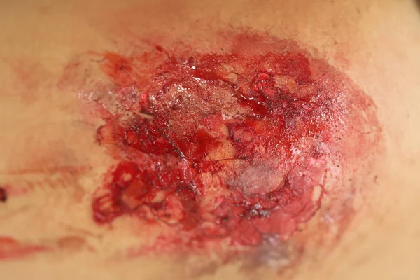 Indian Female Body Wound — Fotografie, imagine de stoc