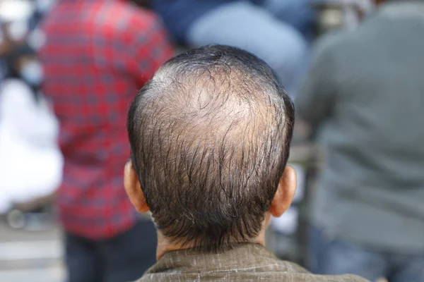 Vista Trasera Del Hombre Cabeza Calva — Foto de Stock