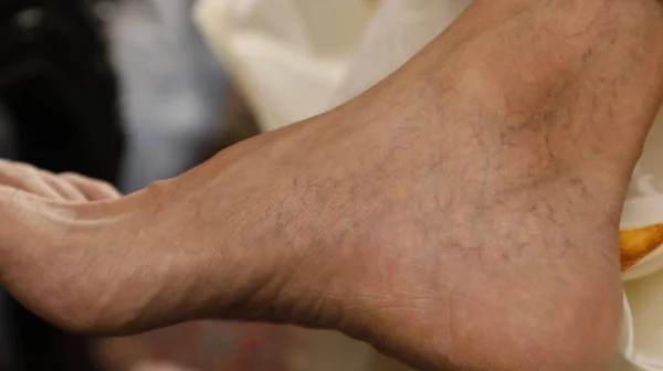 Varicose Veins Male Foot — Foto Stock