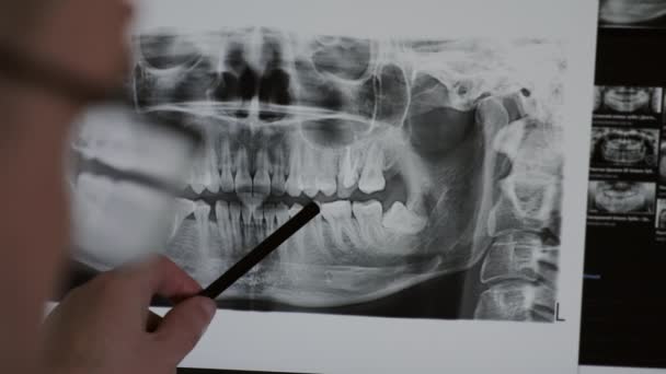 Le docteur examine l'écran de rayons X. pointe vers les zones problématiques sur la numérisation dentaire — Video