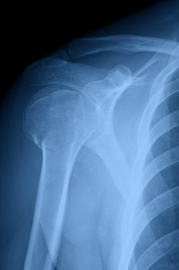 kırık omuz x-ray görüntü