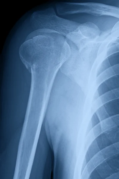 Broken Shoulder X-ray Image Stock Image