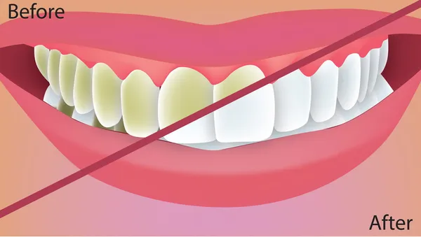 Blanqueamiento de dientes — Vector de stock