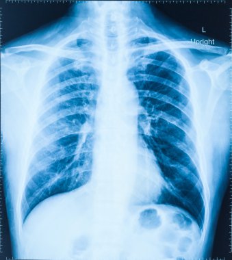 tıbbi tanı için insan göğüs x-ray görüntüsü