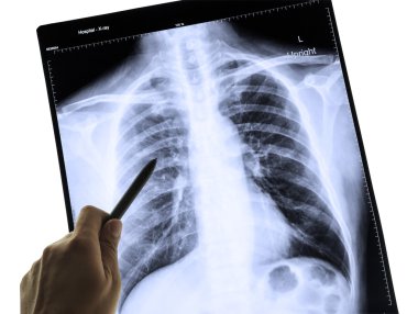 tıbbi tanı ve el poin için insan göğüs x-ray görüntüsü