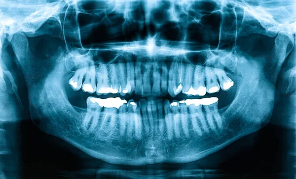 Panoramic Dental Ray Orthopantomogram Single Panoramic Image Oral Cavity Teeth — Zdjęcie stockowe