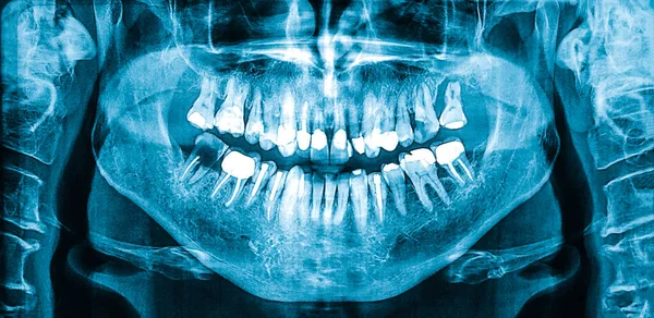 Women Panoramic Dental Radiograph Orthopantomogram Single Panoramic Image Oral Cavity — Zdjęcie stockowe