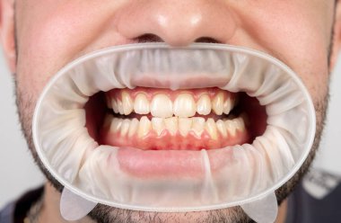 Close-up of a male mouth with normal teeth. Patient at the dentist . clipart