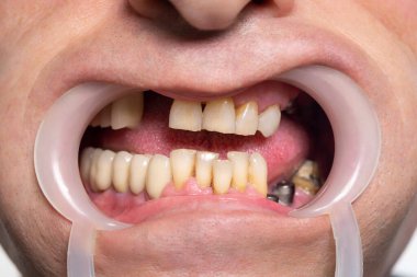 Ağız yerine retraktörle insanın dişlerini kapatıyoruz. Diş hekimindeki hasta. Diş hastalığı. Şiddetli çürük, çürük, diş kaybı. Tedavilerden önce