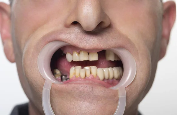 Denti Uomo Con Riavvolgitore Nello Studio Dentistico Malattia Dei Denti — Foto Stock