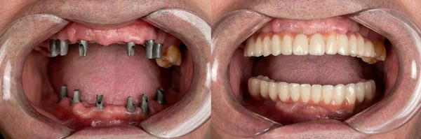 before and after pictures of dental implants and press ceramic crowns