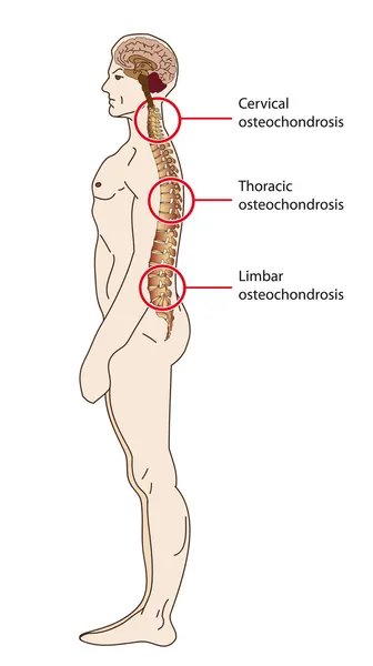 Spinal osteochondrosis — Stock Vector