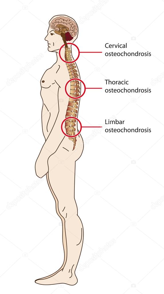 coccyx osteochondrosis osteochondrosis otthon
